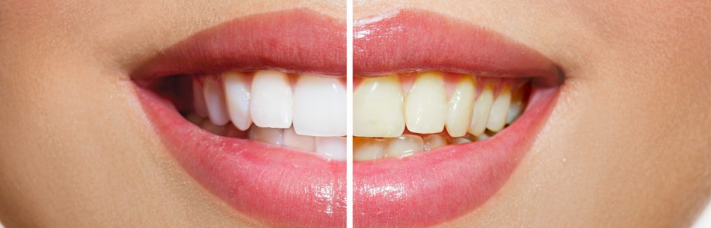 General whitening treatments including in-office and take-home whitening trays.