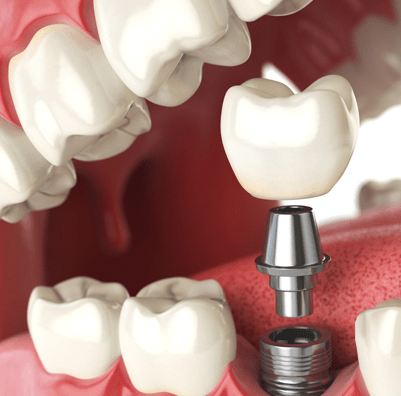 Dental implants are a safe and effective way to restore a smile.